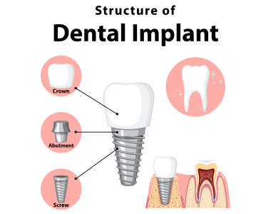 Dental Implants Centerville Ohio